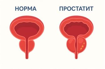 Простатит у мужчин — причины, симптомы и последствия